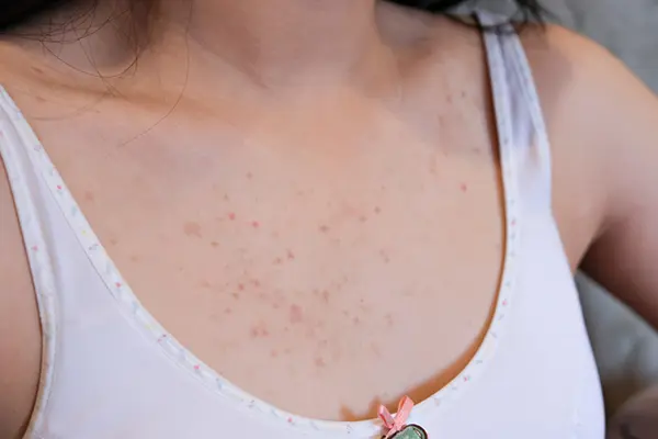 Woman with chest acne. The woman is wearing a white tank top. 