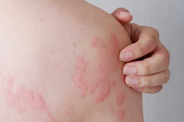 Close up of a shoulder with a rash on it being scratched.