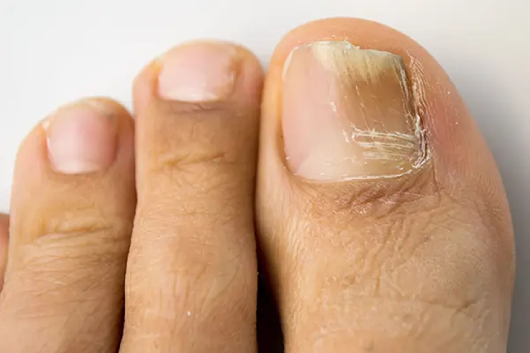 Causes and Treatments of Toenail Fungus