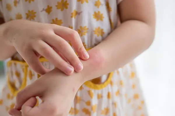 A little girl is itching her arm which has hives on it.
