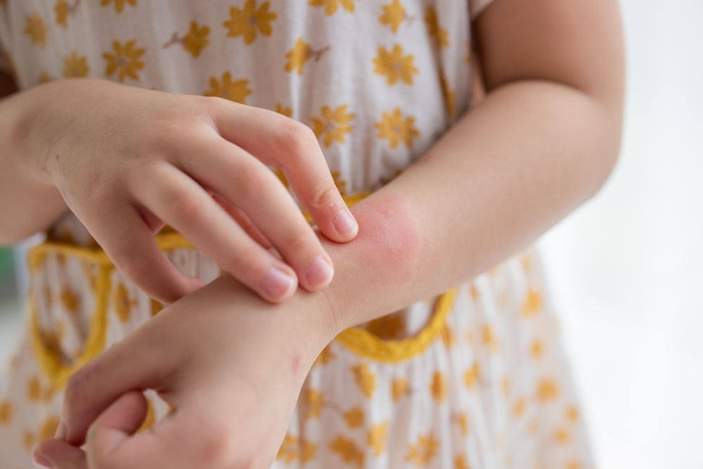 What Virus Causes Hives In Toddlers