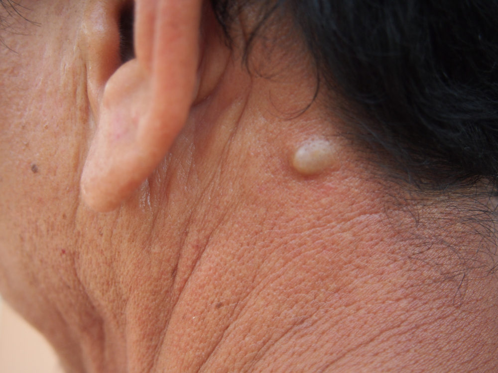 Earlobe Cyst Causes Treatments and More