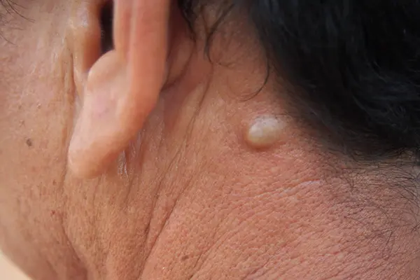 A close-up of a sebaceous cyst on the back of an adult's neck
