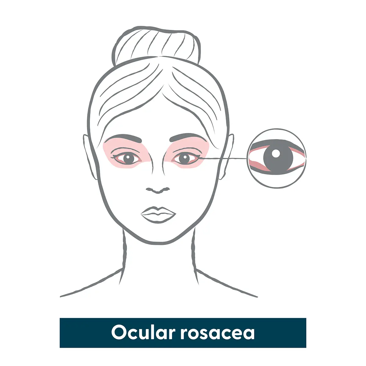 infographic of ocular rosacea