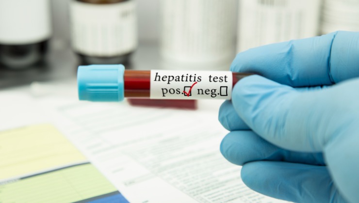 Positive hepatitis test.
