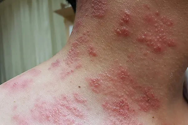 What Does Shingles Look Like On The Neck