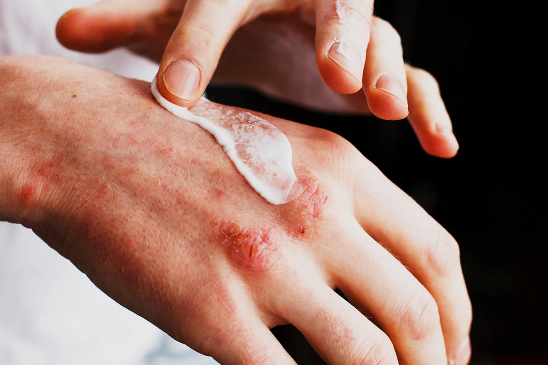 Someone applying cream to hands with eczema.