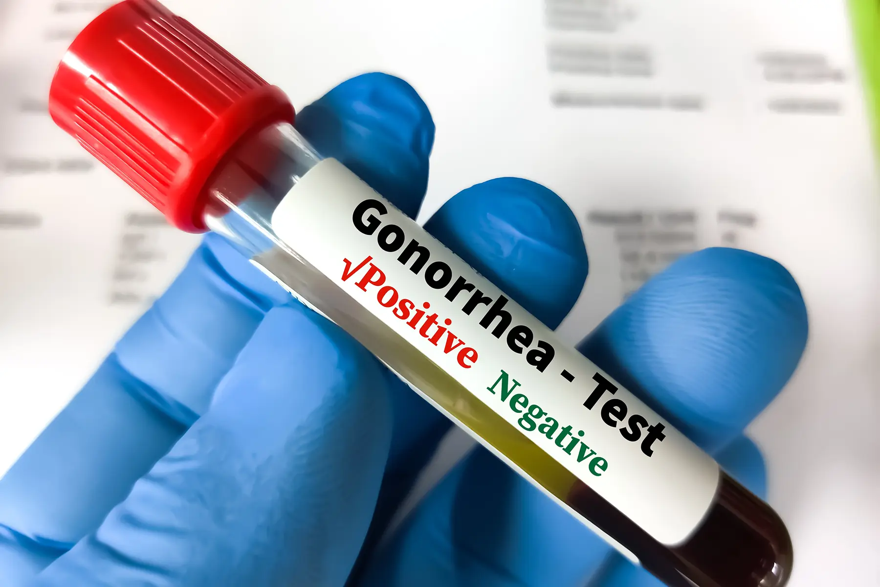 Positive gonorrhea test.