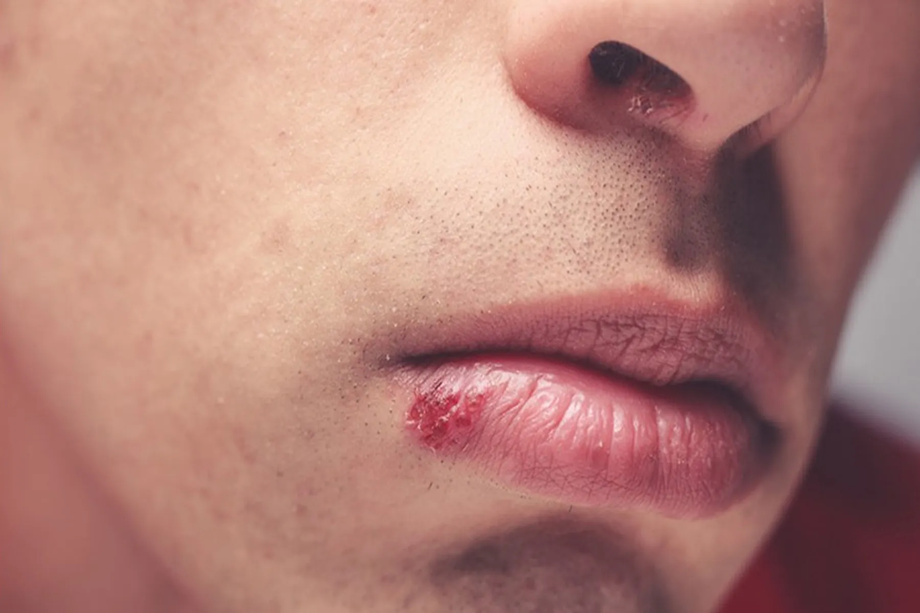 Cold Sores on Lips