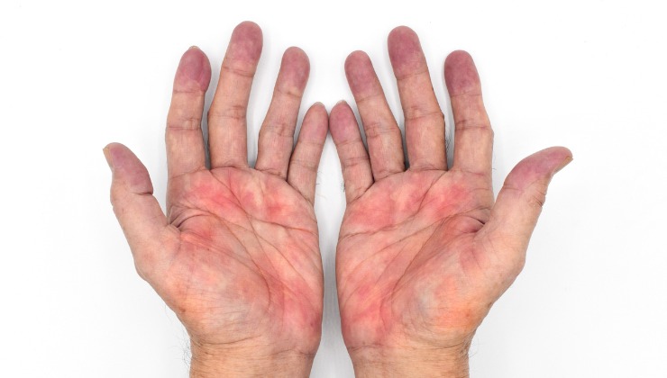 Hands set down on surface, very red palms facing upwards.