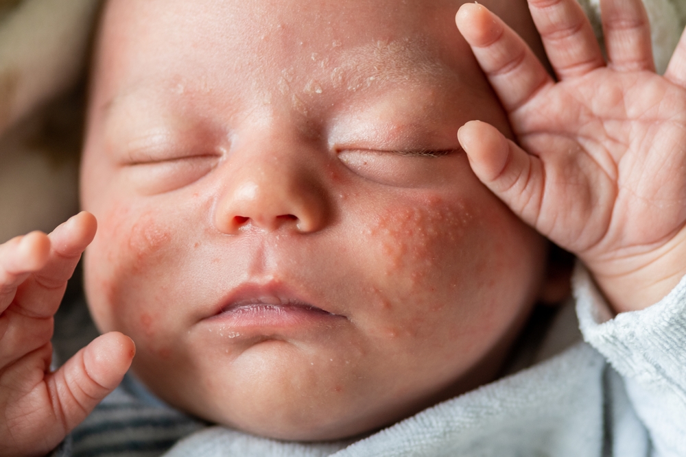 Newborn baby asleep with baby acne on its face.