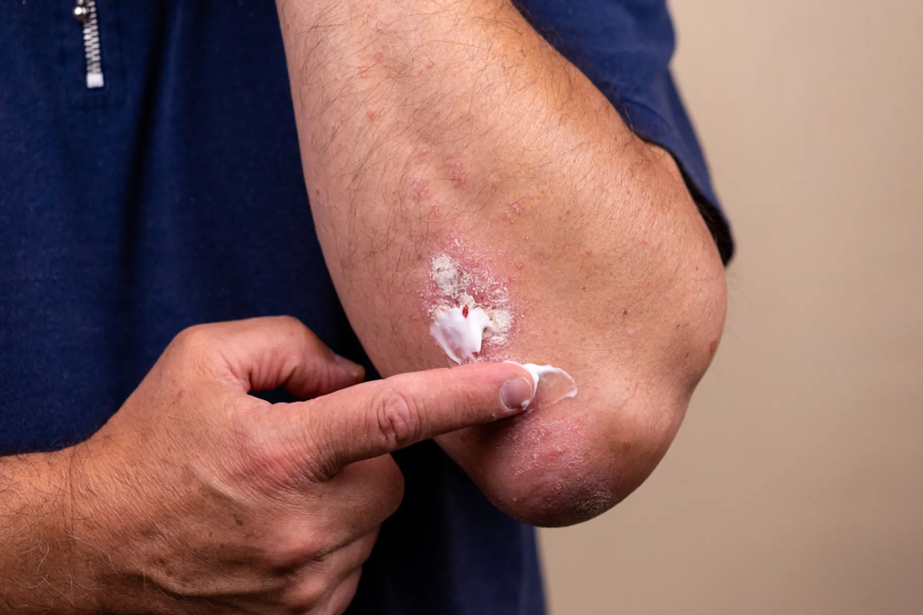 A man applies ointment to a rash on his forearm.