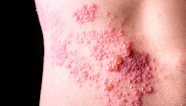 What Does Shingles Look Like LifeMD