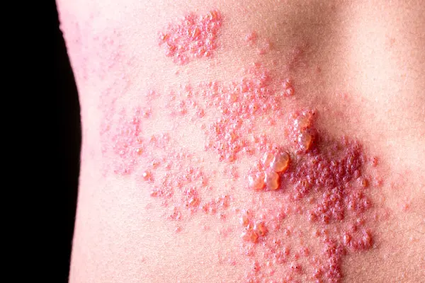 What Does Shingles Look Like? Shingles Rash Pictures