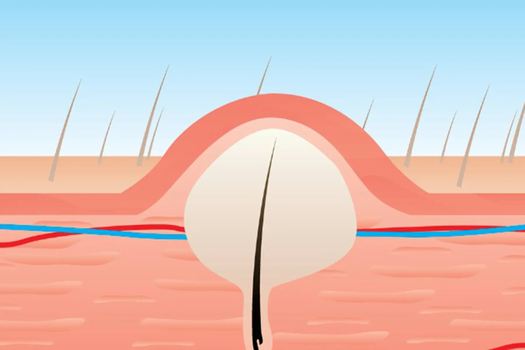 Image of an ingrown hair causing a bump from below the surface of the skin.