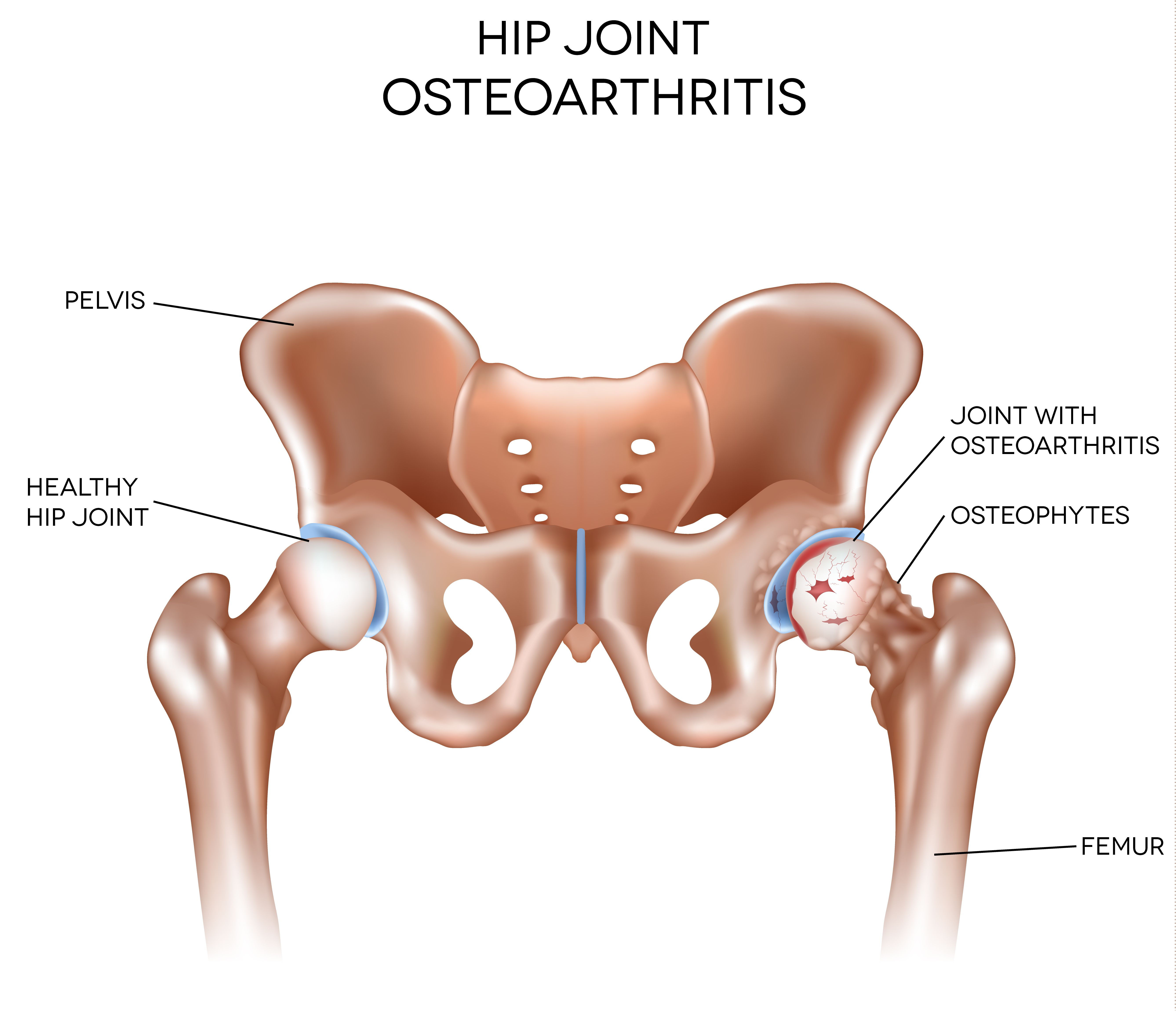 A diagram of the hip showing a healthy joint and a joint with osteoarthritis.