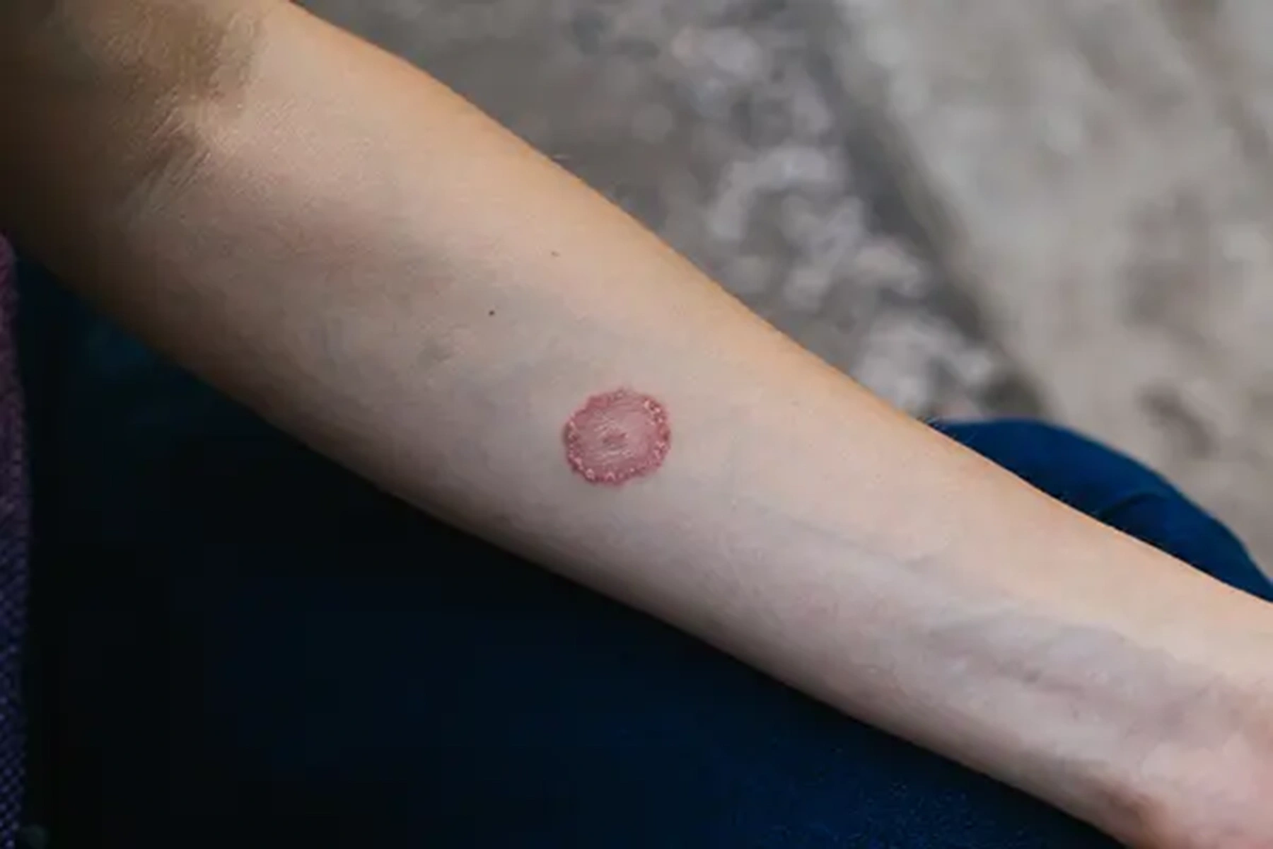 A ringworm rash on the inside of someone's arm.