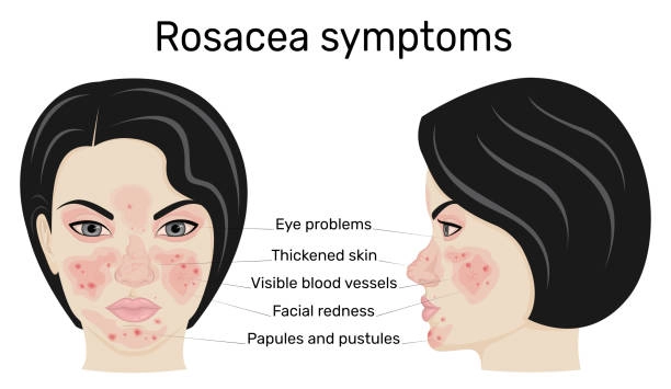 Infographic of rosacea symptoms.