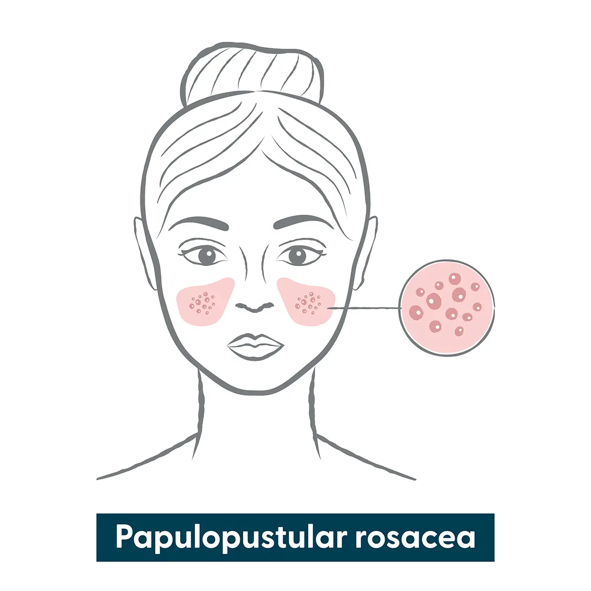 Infographic of papulopustular rosacea