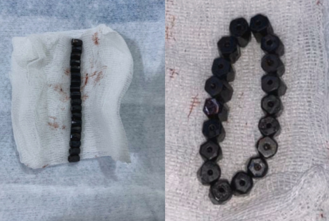 Bracelet after being removed by surgery