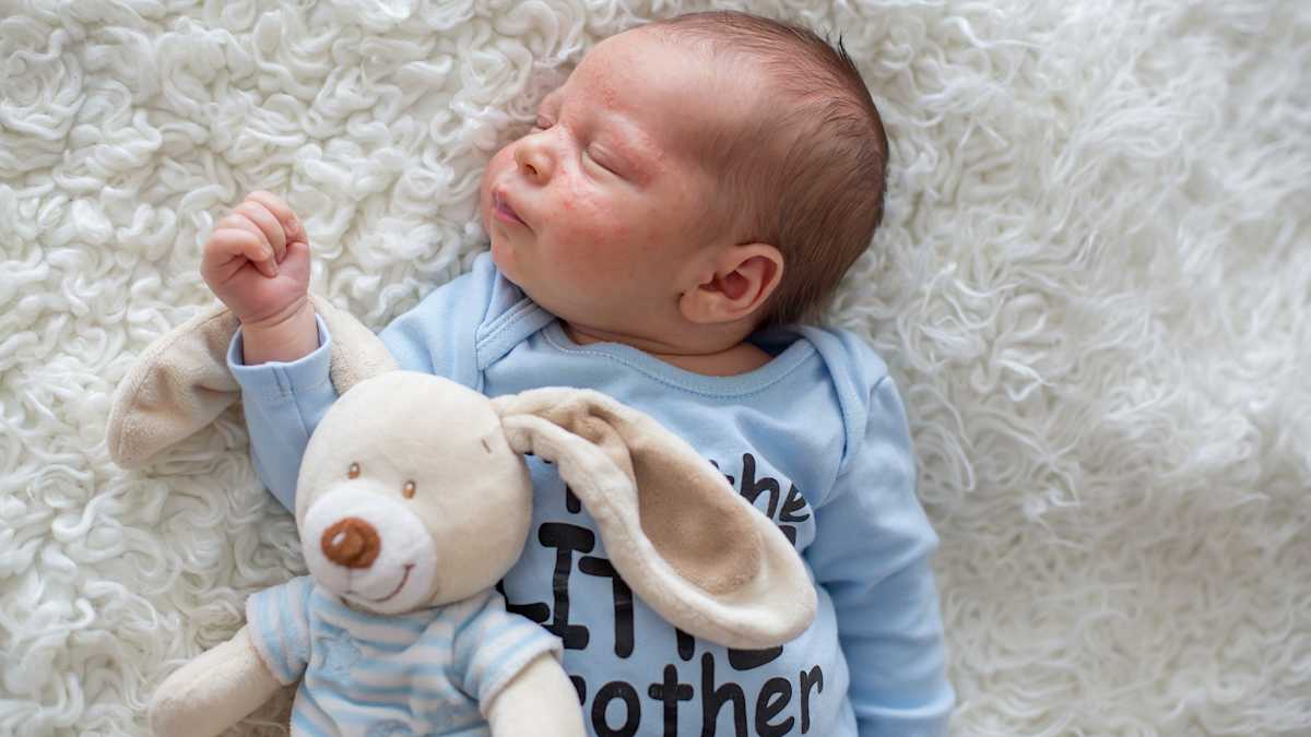 What Causes Baby Facial Acne Mom Com