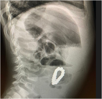 X-Ray shows clearer images of magnetic bracelet in stomach