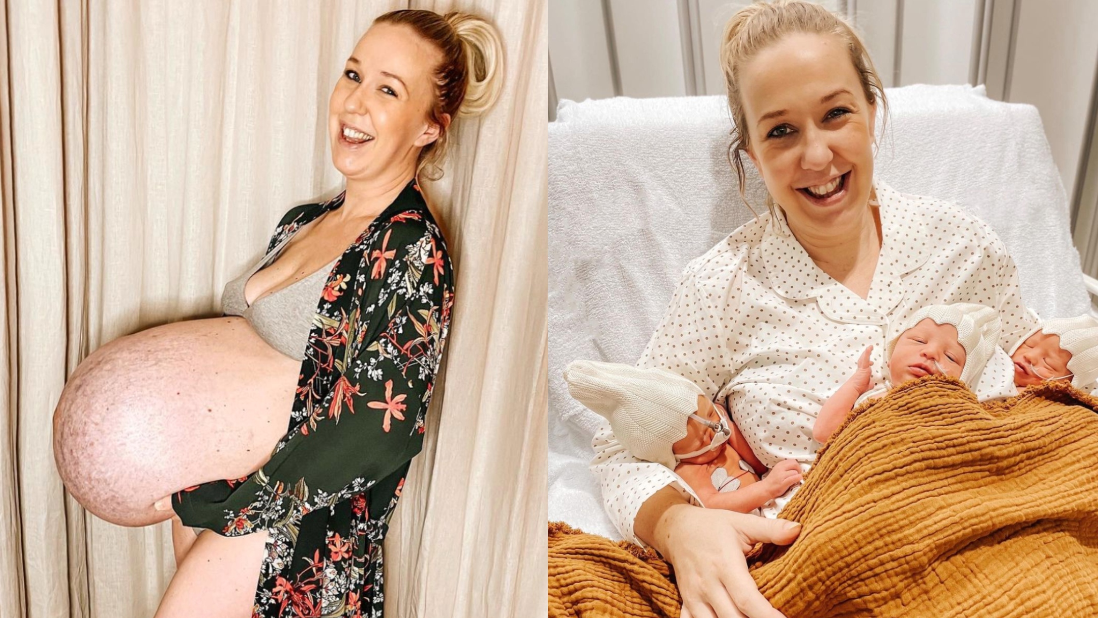 Before & after photos show the reality of a multiples pregnancy