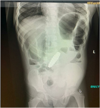 X-Ray showing magnetic bracelet in stomach