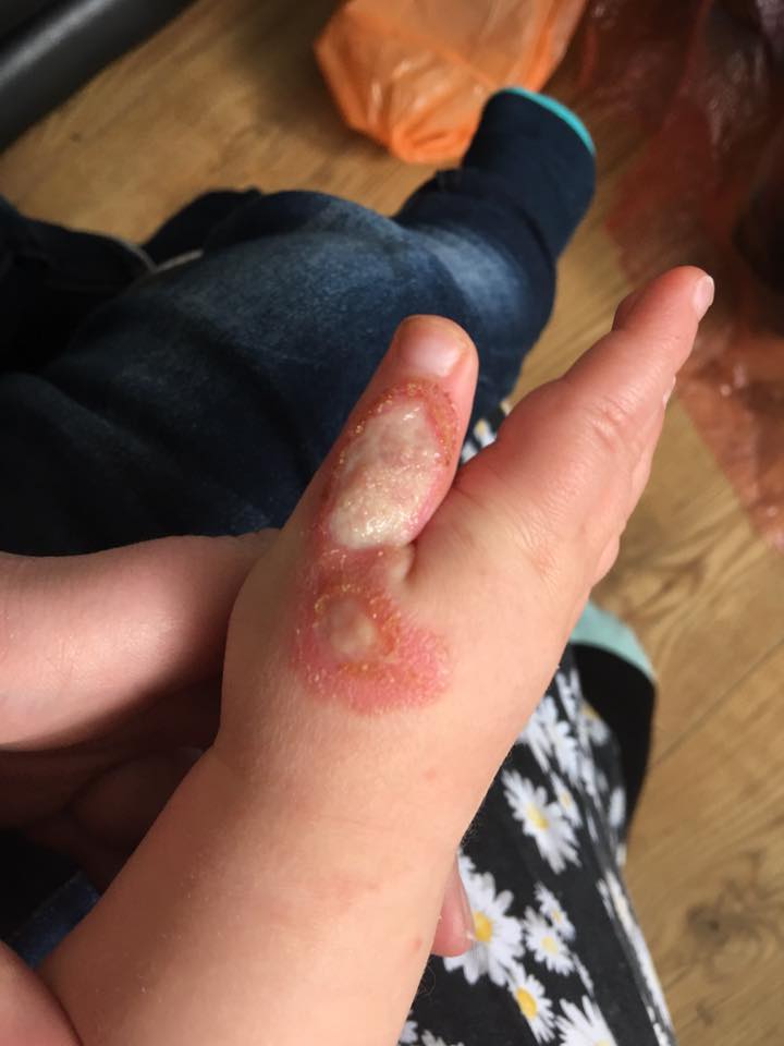 Toddler May Need Surgery After Vacuum Cleaner Injury