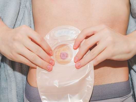 Mann hält ein Stoma, einen künstlicher Darmausgang.