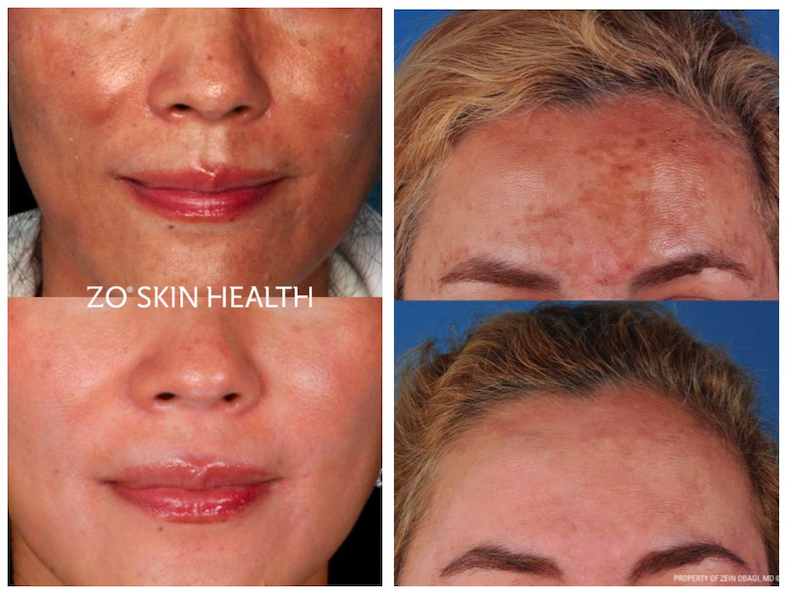 ZO Skin Health - beauty - pigmentatie - resultaat