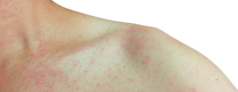 Hautausschlag – Symptome, Ursachen und Therapie | Fernarzt