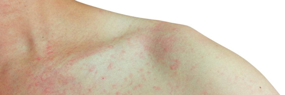 Hautausschlag Symptome Ursachen Und Therapie Fernarzt Hautausschlag Symptome Ursachen Und Therapie Fernarzt