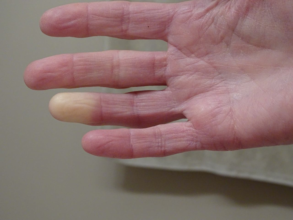 Raynaud-Syndrom: Hand mit weißer Verfärbung am Endglied des Ringfingers.