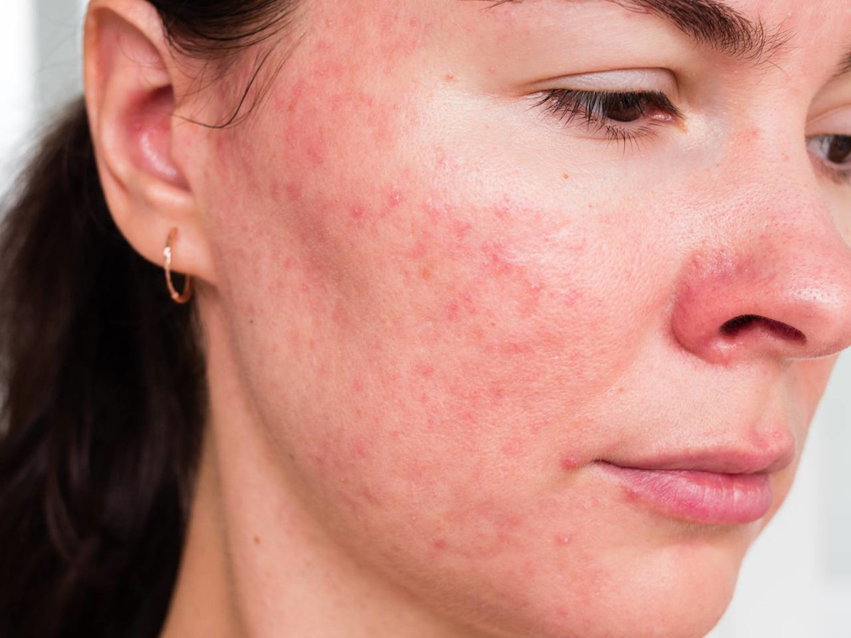 Im Gesicht einer Frau sind Hautveränderungen auf den Wangen zu sehen. Es handelt sich um Rosacea, diese chronisch-entzündliche Hauterkrankung wird auch Rosazea, Kupferrose oder Kupferfinne genannt.