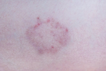 Hautpilz als runde Veränderung auf der Haut.