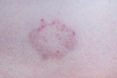 Hautpilz als runde Veränderung auf der Haut.