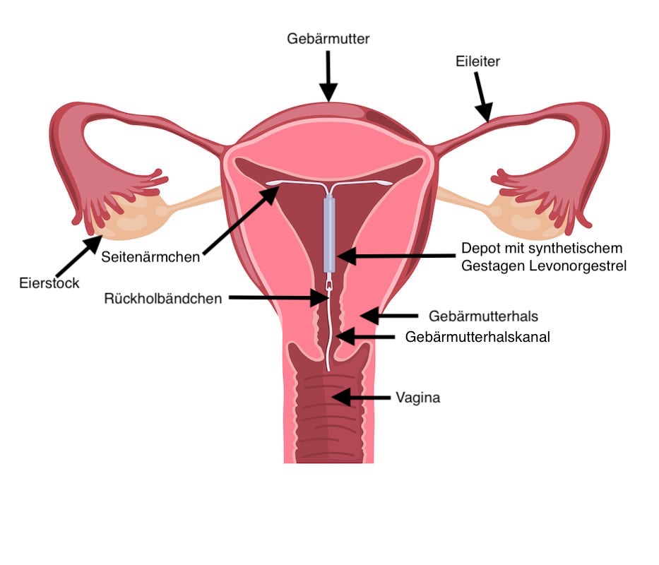 Nach entfernung hormonumstellung mirena Hatte schonmal