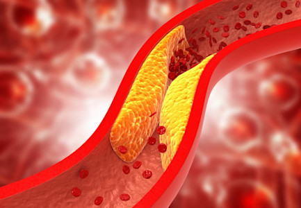 Grafische Darstellung von Blutgefäßen mit Ablagerung zur zu hohe Cholesterinspiegel. 