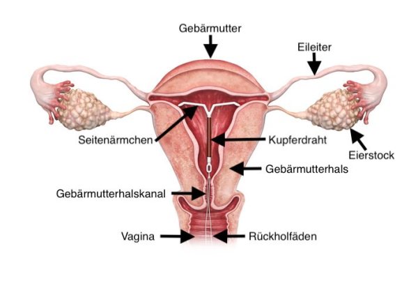 Hormonspirale verhütung Kupfer