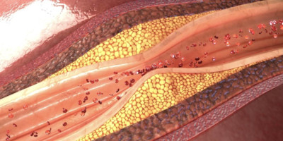 Grafische Darstellung von Blutgefäßen mit Fettablagerungen. Gefäßverengung und Arteriosklerose durch erhöhte Cholesterinwerte.