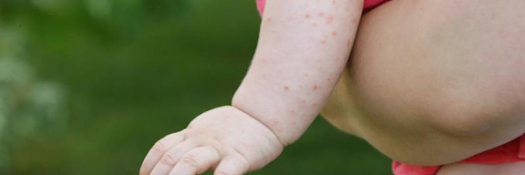 Scharlach Ursachen Symptome Behandlung Pravention Fernarzt Scharlach Ursachen Symptome Behandlung Pravention Fernarzt