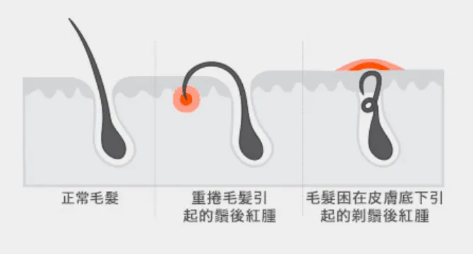 剃須後紅腫：問題的原因
