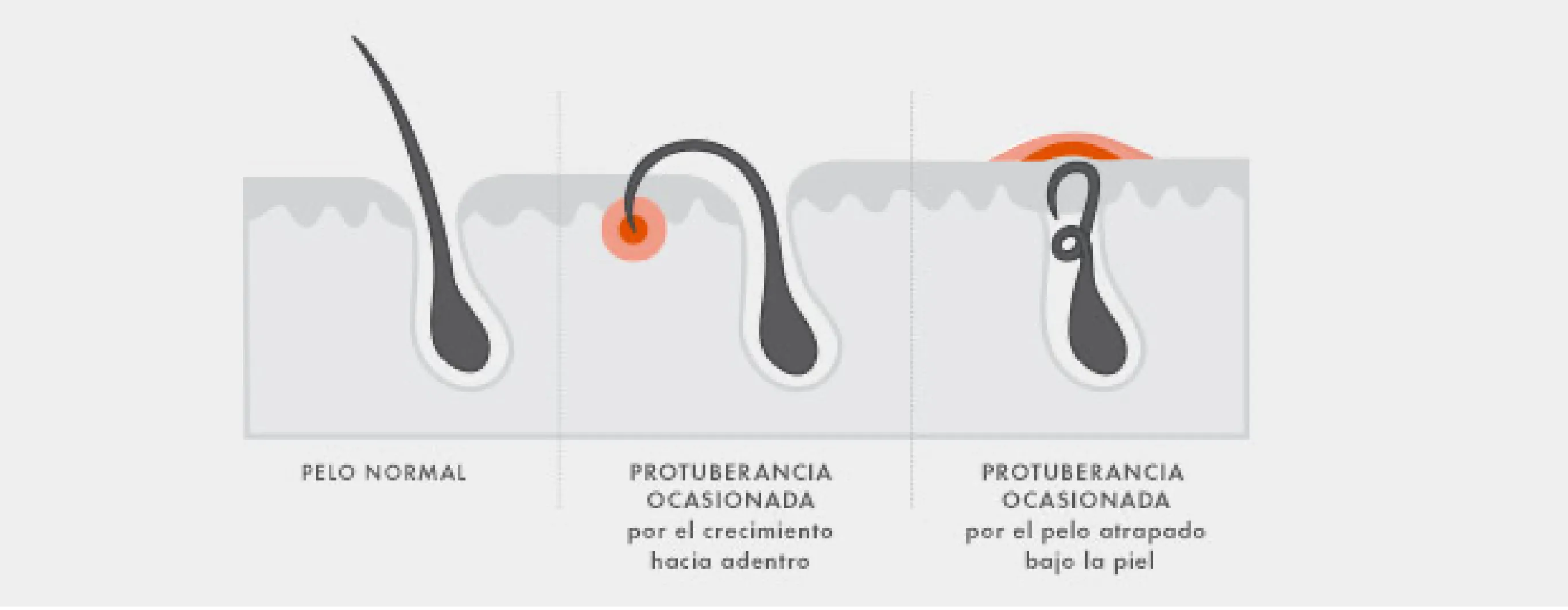 Cabello normal versus protuberancia causada por el nuevo rizo versus protuberancia causada por el cabello atrapado debajo de la piel