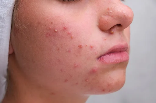 acne_vulgaris_mysummer