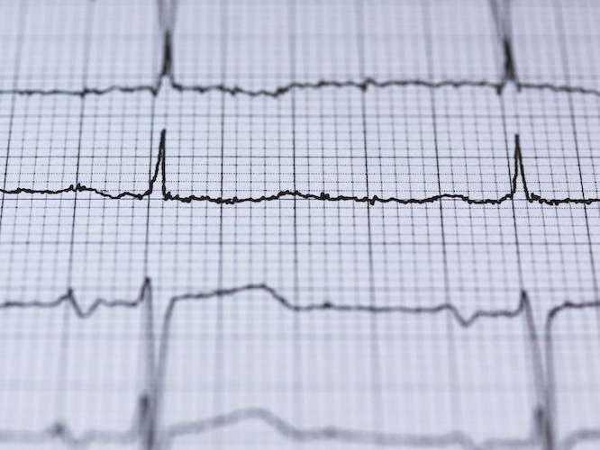 ECG readout on white paper