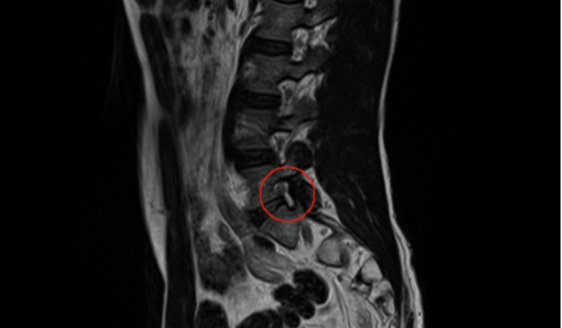 Prenuvo MRI results lumbar spine 