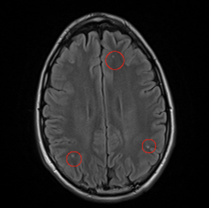 Prenuvo MRI results brain image with white spots