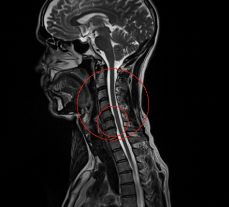  C4-C5 disk Prenuvo MRI Results 