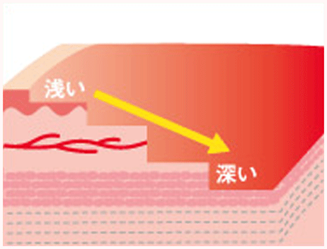 軽度のやけどの断面